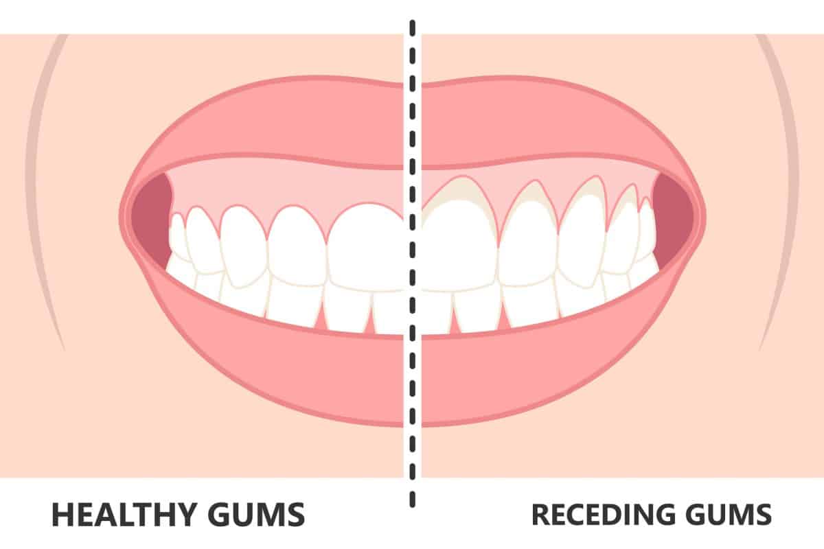 What Is the Cause of My Receding Gums?