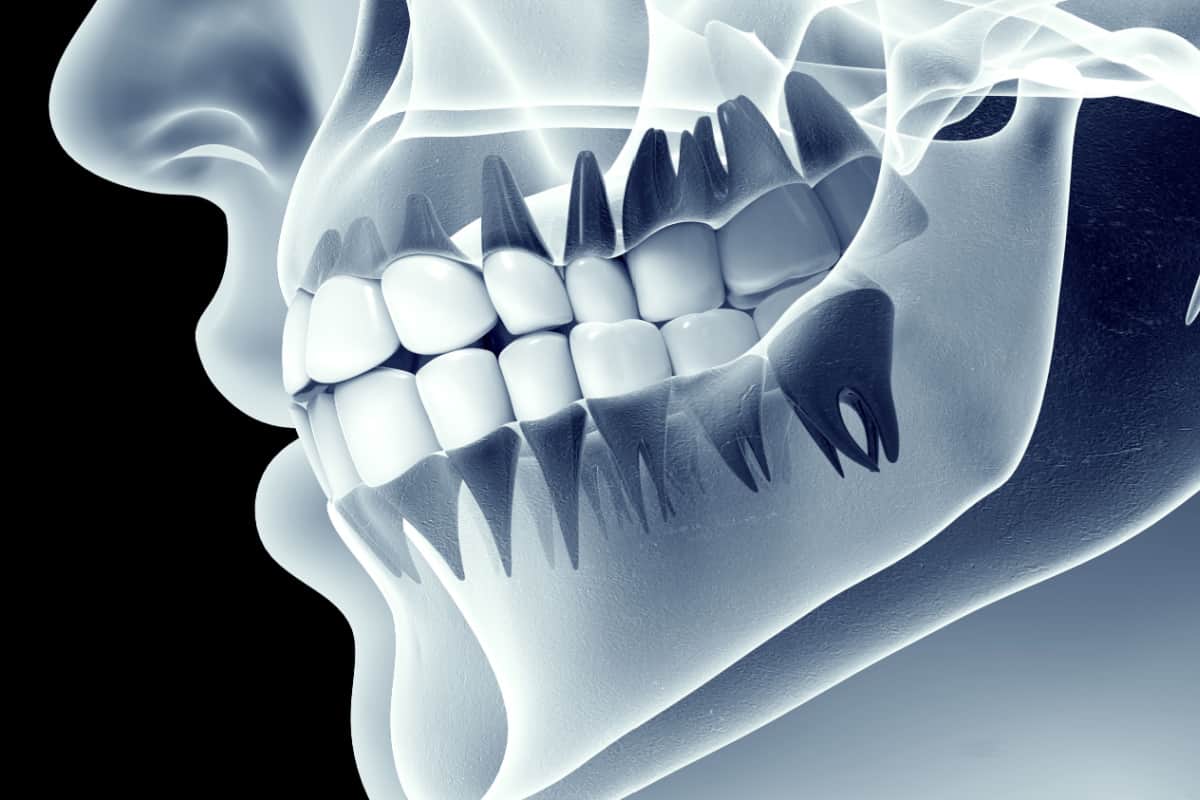 Am I a Candidate for Sinus Augmentation Surgery?